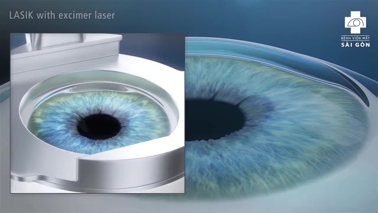 So sánh giữa LASIK và Femtosecond LASIK
