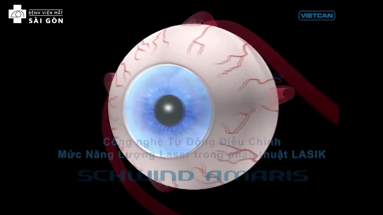 TÌM HIỂU TÍNH ƯU VIỆT CỦA CÔNG NGHỆ TỰ ĐỘNG ĐIỀU CHỈNH MỨC NĂNG LƯỢNG LASER TRONG PHẪU THUẬT LASIK CỦA MÁY SCHWIND AMARIS 1050S TẠI MẮT SÀI GÒN