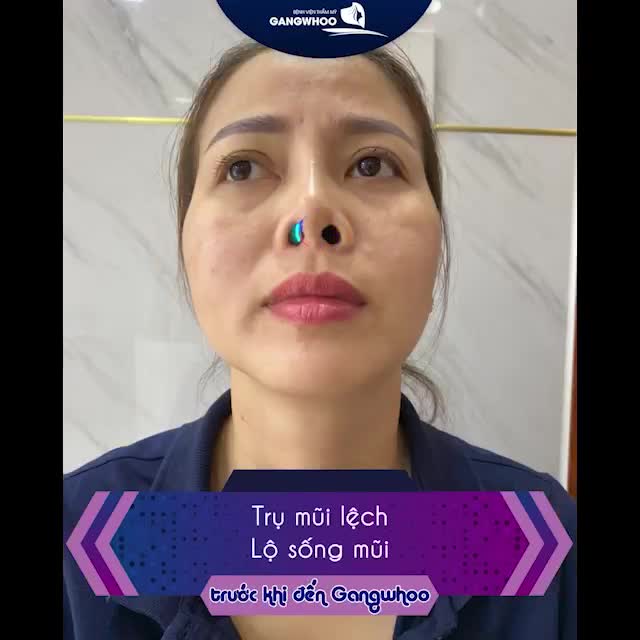 TOP 5 TRƯỜNG HỢP MŨI HỎNG ĐƯỢC GIẢI CỨU
