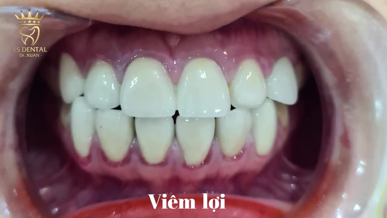 Video cảm nhận thực tế kh Hoàn thành xong ca thẩm mỹ 12 răng sứ tại nha khoa  XS .