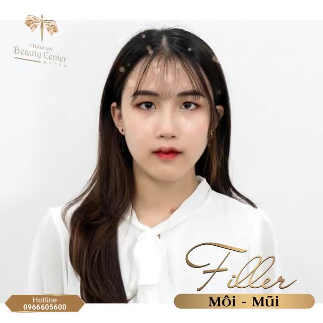 30 phút để có sống mũi cao tây và môi tim sexy nhờ Filler môi- mũi.