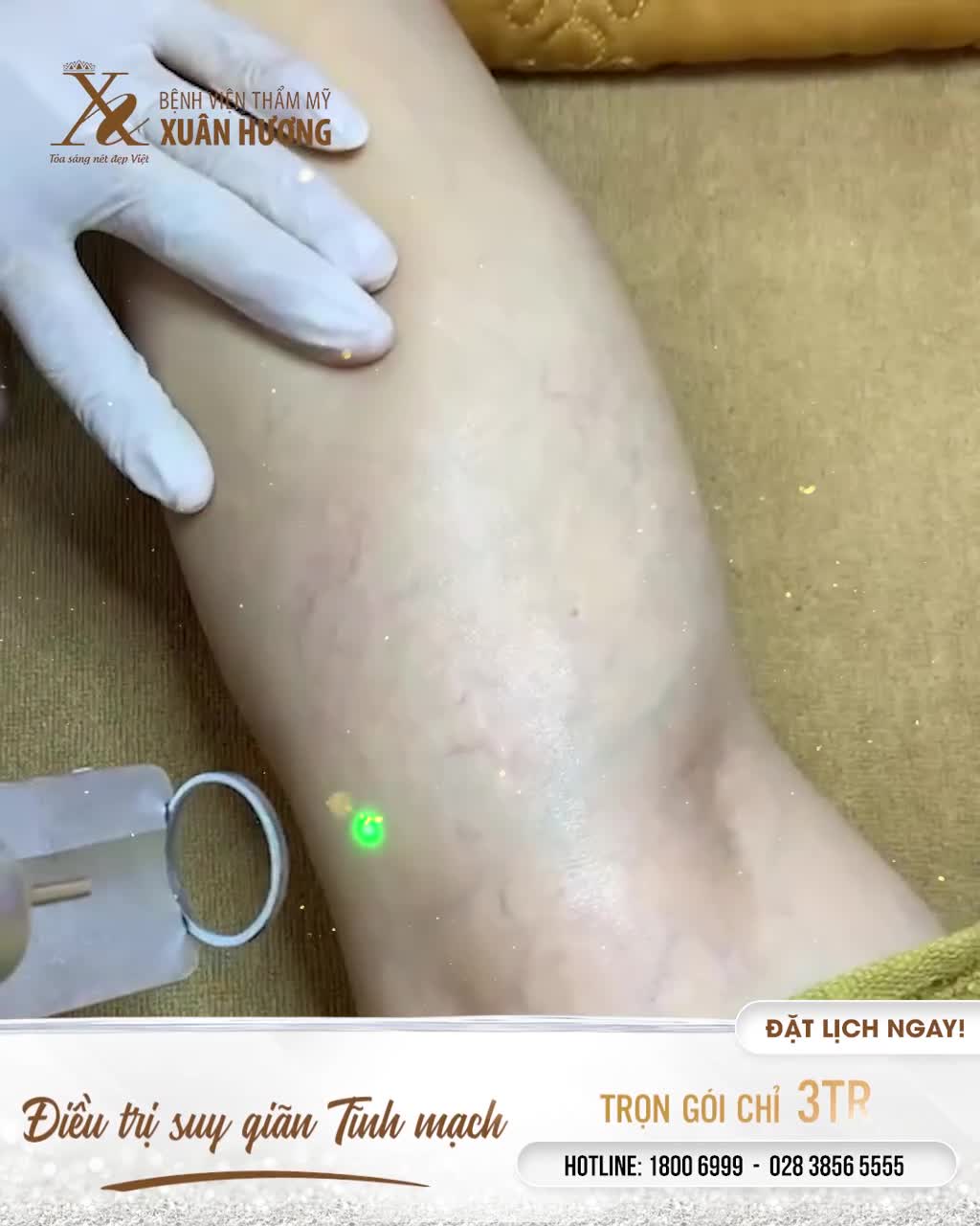 ĐIỀU TRỊ SUY GIÃN TĨNH MẠCH HIỆU QUẢ TRỌN GÓI CHỈ 3 TRIỆU ĐỒNG
