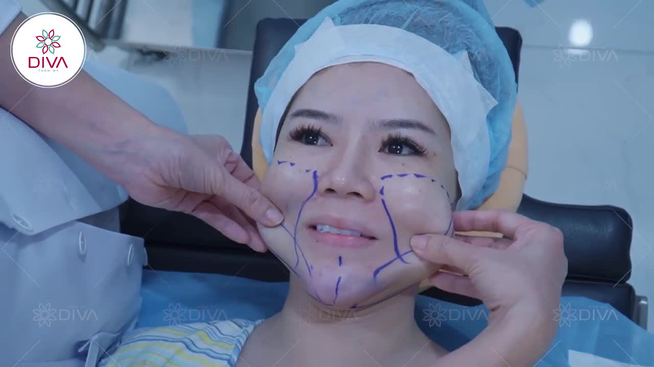 GIẢI PHÁP CẢI THIỆN MẶT TO, MỠ DÀY DƯỚI DA LÀ GÌ ?