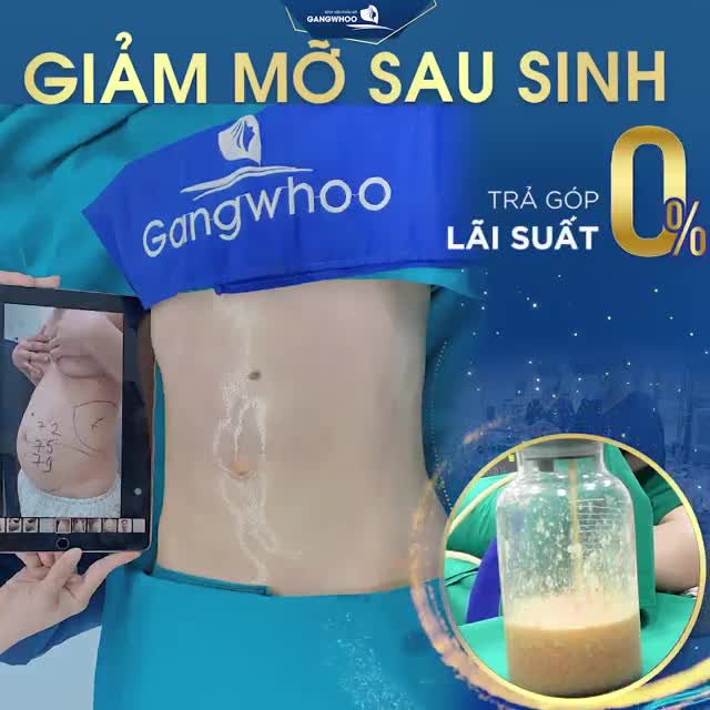 GIẢM MỠ BỤNG SAU SINH VỚI GIÁ CỰC RẺ!!!