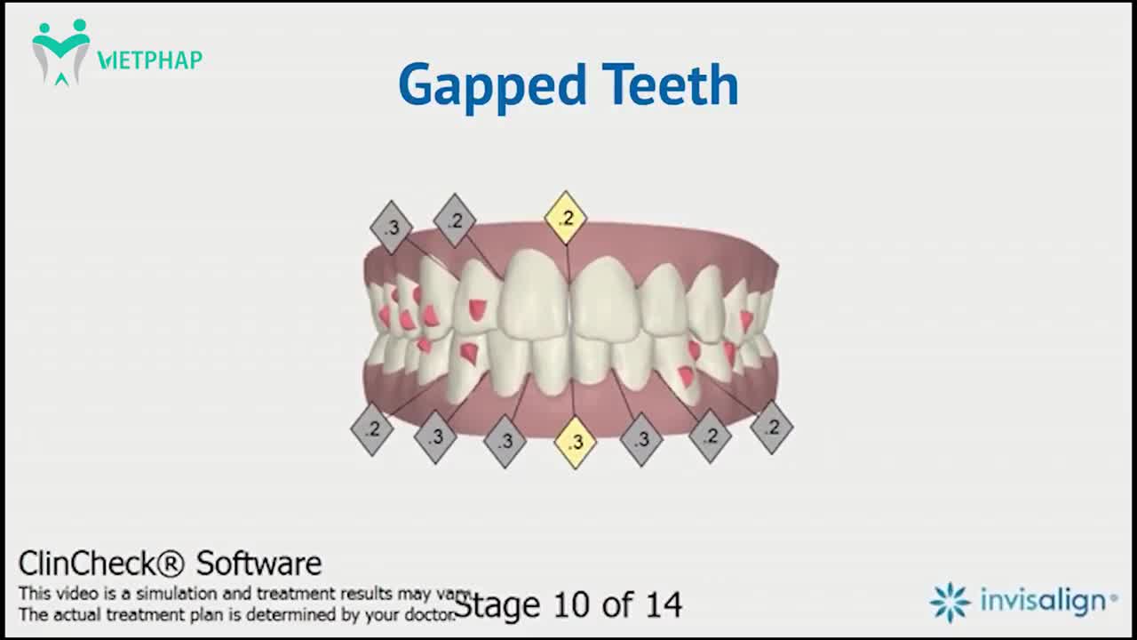 NHỮNG ĐIỀU CẦN LƯU Ý KHI DUYỆT PHIM CLINCHECK NIỀNG RĂNG INVISALIGN