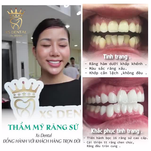 Phương pháp BỌC SỨ THẨM MỸ - Làm đẹp cho răng chưa đủ, đẹp tự nhiên mới là hoàn hảo