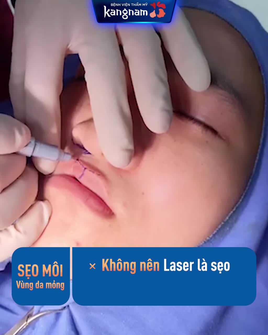 Sửa SẸO MÔI? Nên LASER là sẹo hay PHẪU THUẬT?