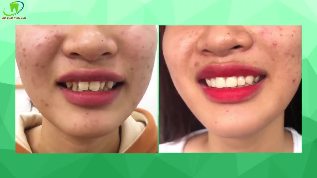 THAY ĐỔI NỤ CƯỜI, TỰ TIN GIAO TIẾP