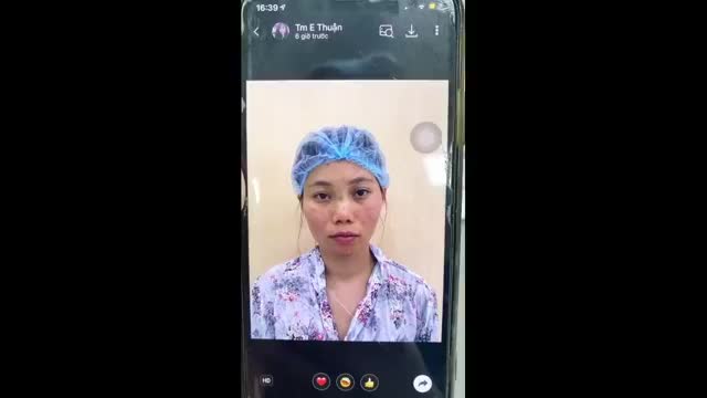 Combo Hạ gò má+ mài góc hàm+ độn cằm sụn Mỹ+ Mũi GL …