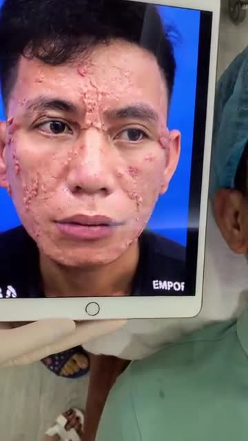 Quá trình điêu trị sẹo lồi cho khách hàng với tình trạng Phức tạp