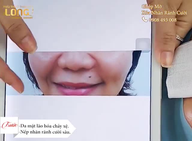 KHÁCH HÀNG SAU QUÁ TRÌNH XÓA BAY RÃNH RÂU RỒNG