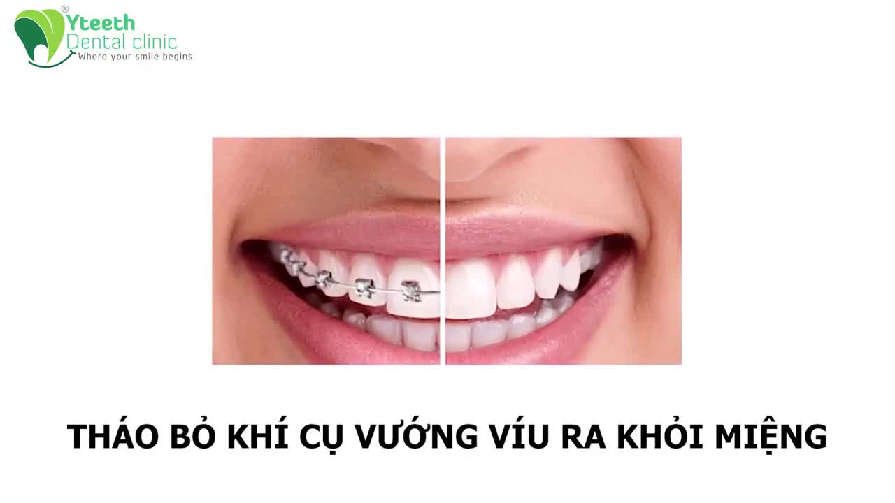 Nghe CHUYÊN GIA CHỈNH NHA hướng dẫn cách CHĂM SÓC RĂNG SAU THÁO NIỀNG