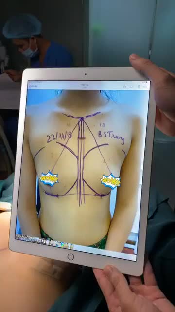 CASE NÂNG NGỰC THỨ 3 TRONG NGÀY TẠI DR NGỌC TRUNG.