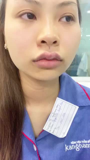 kết quả phẫu thuật tạo hình môi tim ở Kangnam Hà Nội chiều nay!!!