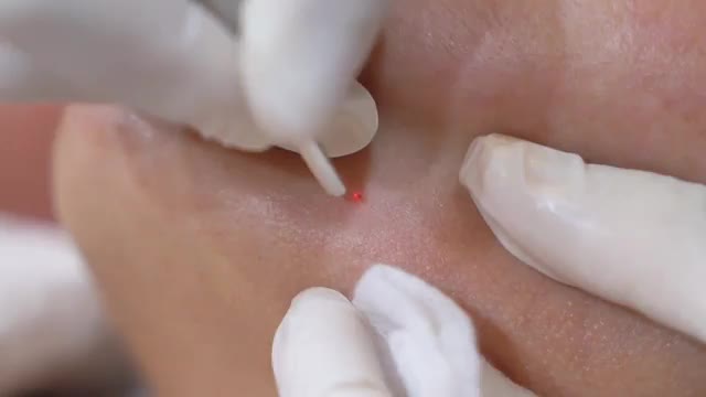 Tẩy nốt ruồi có đau không? Mời cả nhà cùng đón xem