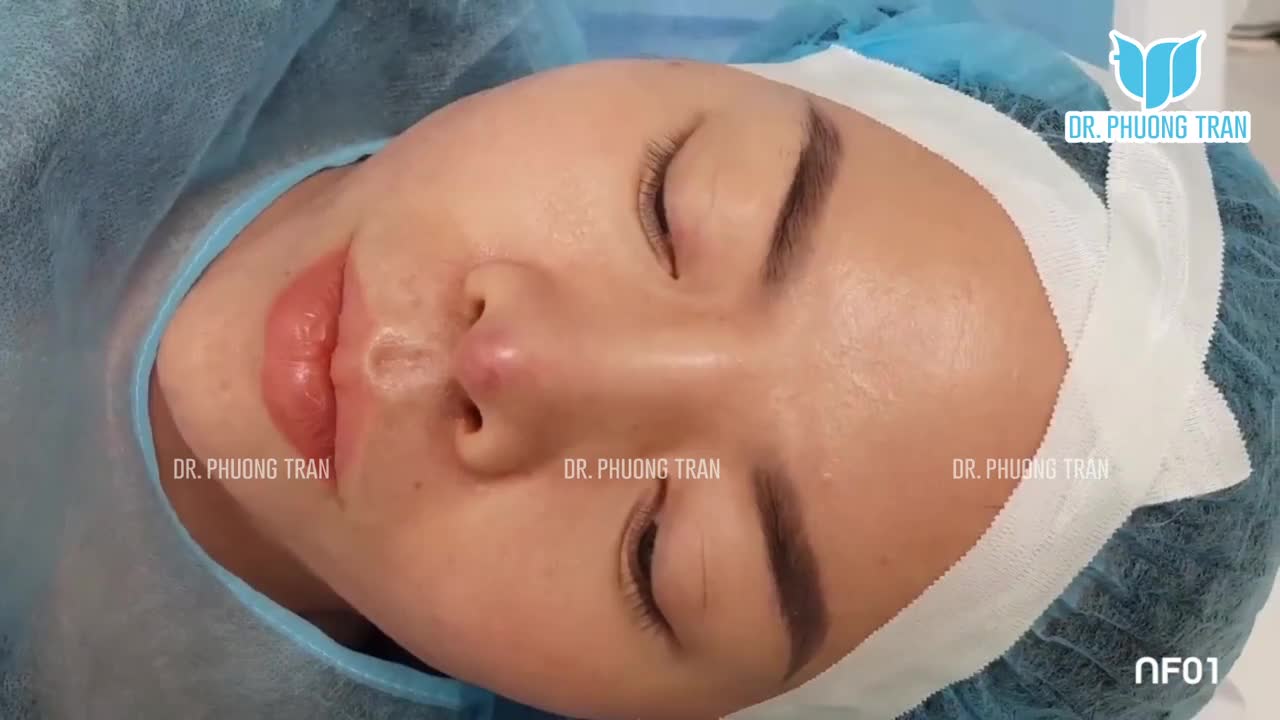 MỘT CA ĐẶT TRUNG BÌ MỠ ĐỂ XỬ LÝ BIẾN CHỨNG