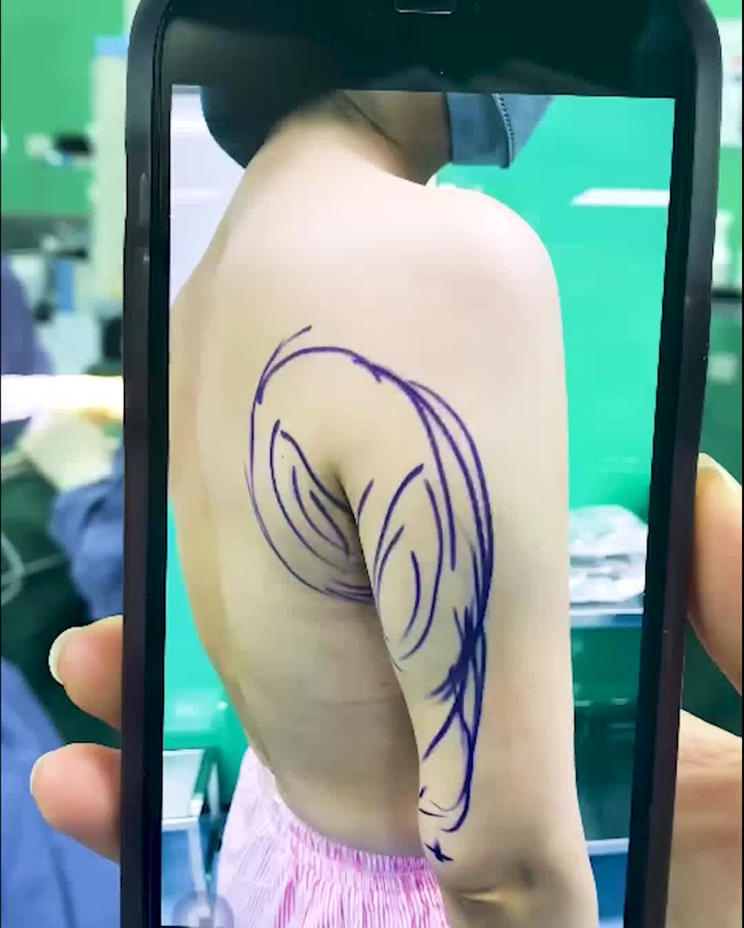 CẬN CẢNH CA HÚT MỠ BẮP TAY CHO BÀ MẸ 2 CON