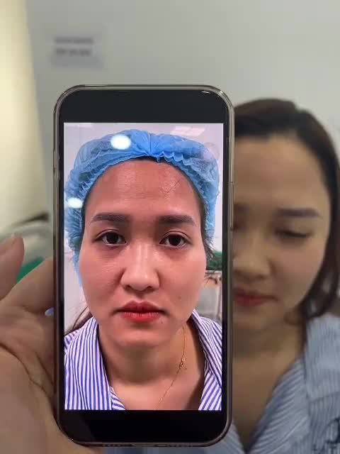 mặt đầy đặn sau 45p độn thái dương