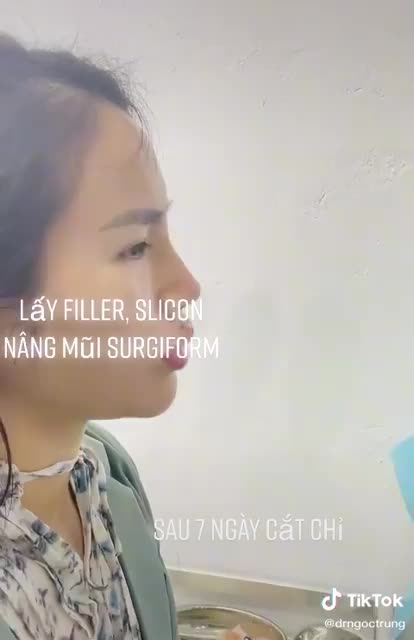 Lấy filler, nạo silicon và sửa mũi thành công cho khách. Video khách  tái khám sau 7 ngày