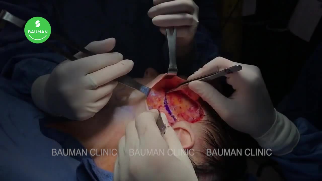 Cận cảnh quá trình bóc tách lớp SMAS, khâu theo nhiều hướng tối ưu kết quả căng da mặt