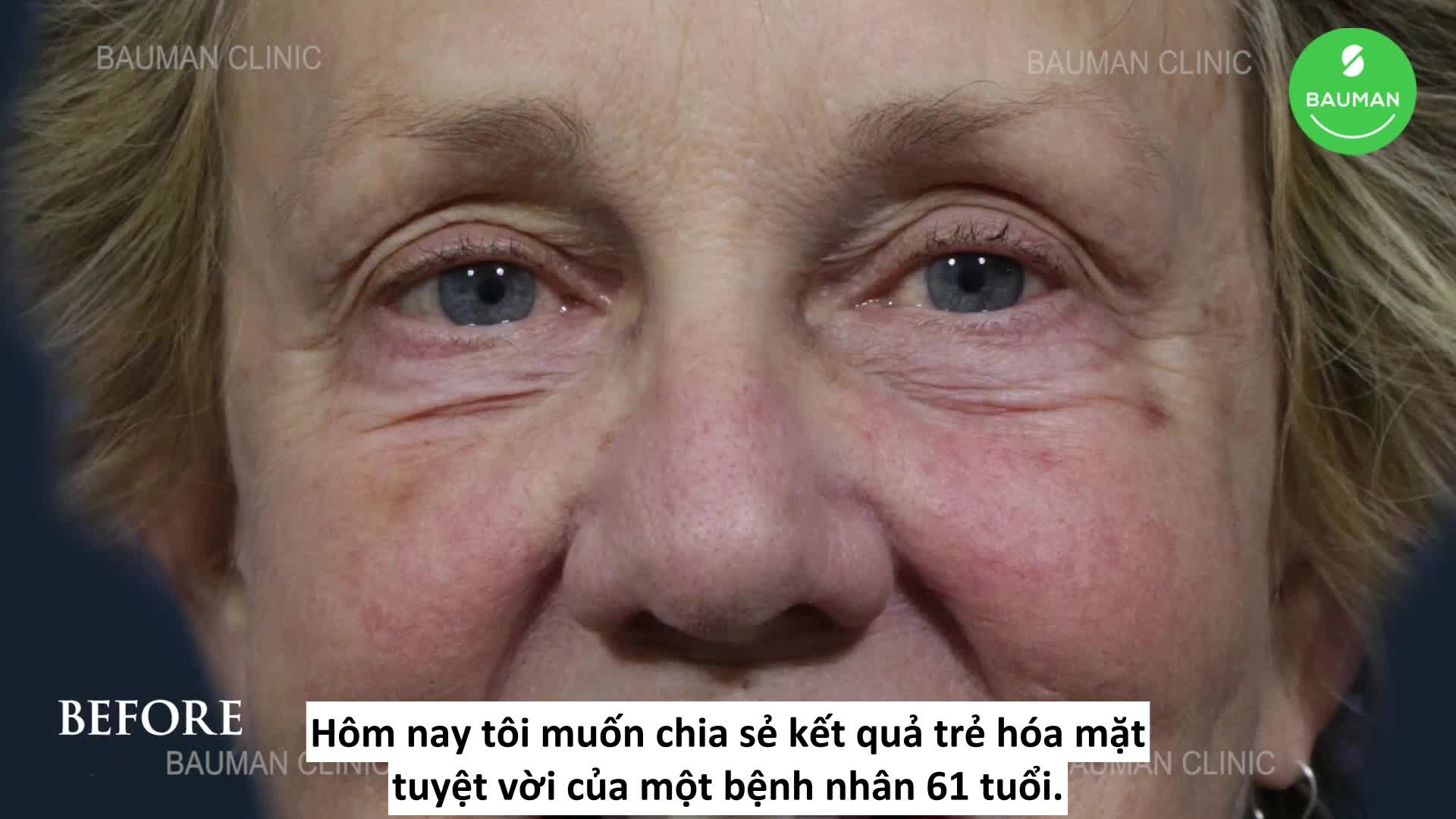 Trẻ hóa mặt khách hàng nữ 61 tuổi
