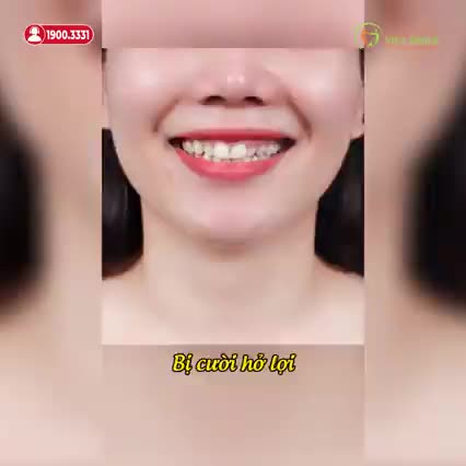 BỌC SỨ THẨM MỸ - RĂNG TRẮNG ĐẸP TỰ NHIÊN, NỤ CƯỜI TỰ TIN