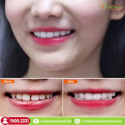 BỌC SỨ THẨM MỸ - ĐÓNG KHE THƯA, RĂNG ĐẸP, CƯỜI XINH