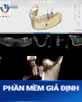ĐỘT PHÁ TRỒNG RĂNG CHUẨN PHÁP 2022