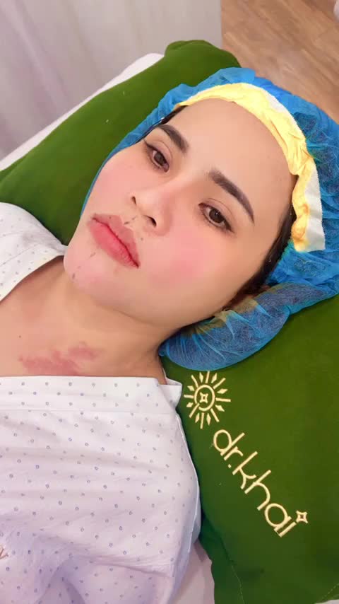 DÁNG CẰM VỪA ĐỘN V-LINE VÀ TIÊM FILLER ĐẦY RÃNH CƯỜI