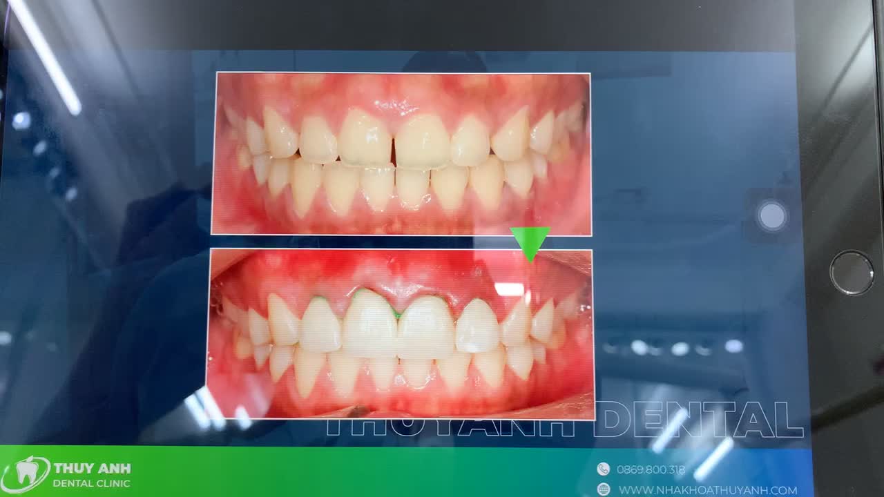 Gắn Veneer cố định khắc phục tình trạng răng thưa cho chị khách hàng tại Nha Khoa Thuỳ Anh.