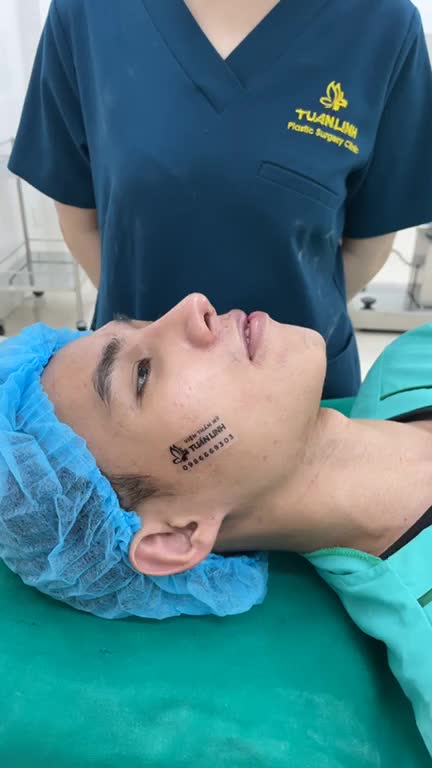 Ca cắt môi vừa hoàn thành