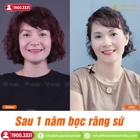 CẢM NHẬN SAU 1 NĂM BỌC RĂNG SỨ THẨM MỸ