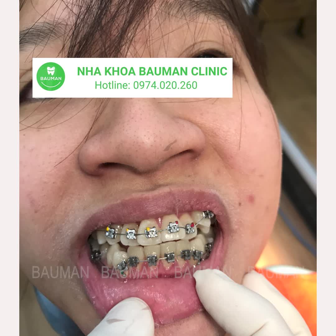 Ca niềng răng 5223| Nha Khoa Bauman