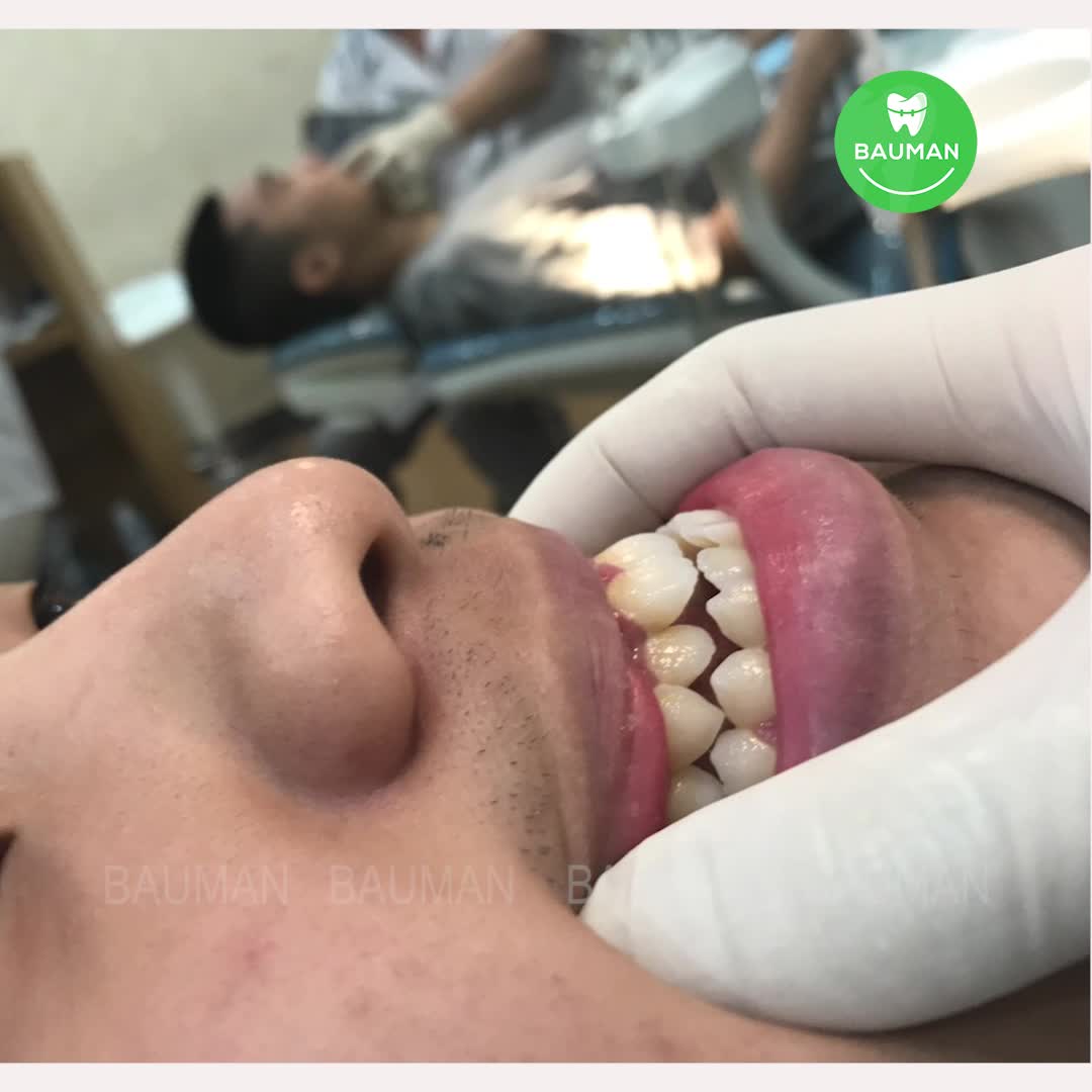 Ca niềng răng 5225| Nha Khoa Bauman