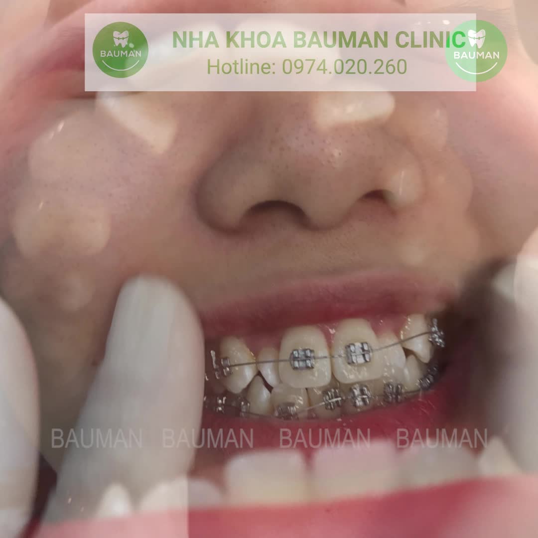Ca niềng răng 5228| Nha Khoa Bauman