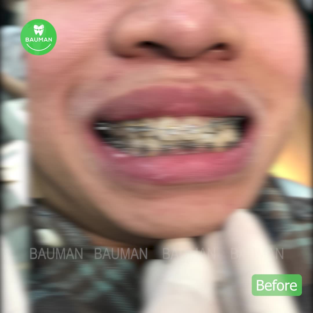 Ca niềng răng 5230| Nha Khoa Bauman