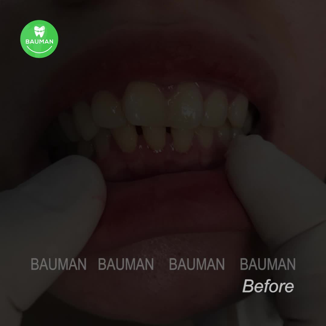 Ca niềng răng 5246| Nha Khoa Bauman