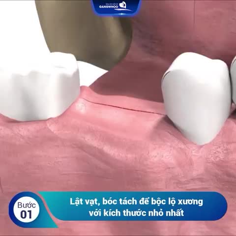TRỒNG RĂNG IMPLANT 1 LẦN SỬ DỤNG ĐẾN 1 ĐỜI