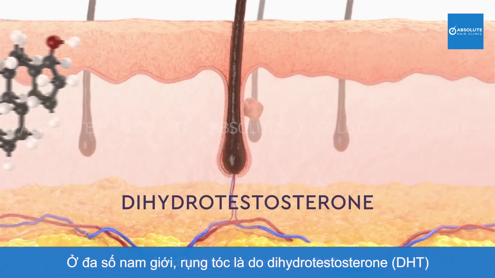 Cấy tóc FUE là gì, thực hiện như thế nào?