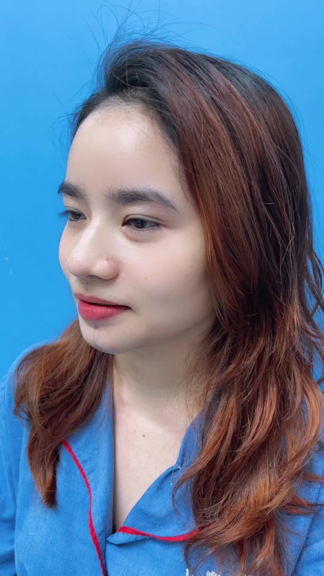 Độn cằm - Chỉ 15 phút sở hữu ngay gương mặt xinh xắn và góc nghiêng tỉ lệ vàng