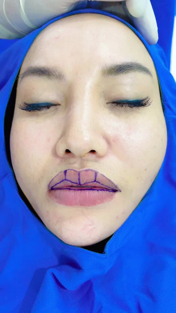 Tạo hình môi tim trên và thu mỏng môi dưới
