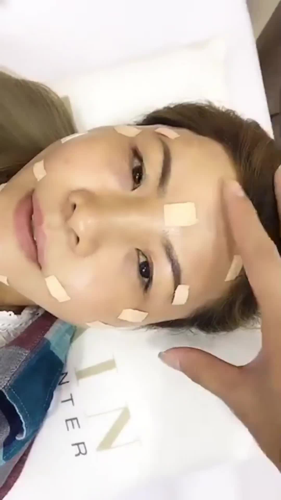 CHỊ KHÁCH HÀNG BIẾN HÌNH SAU 1 NGÀY CẤY MỠ TOÀN MẶT