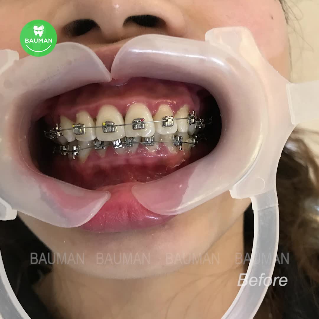 Ca niềng răng 5253| Nha Khoa Bauman