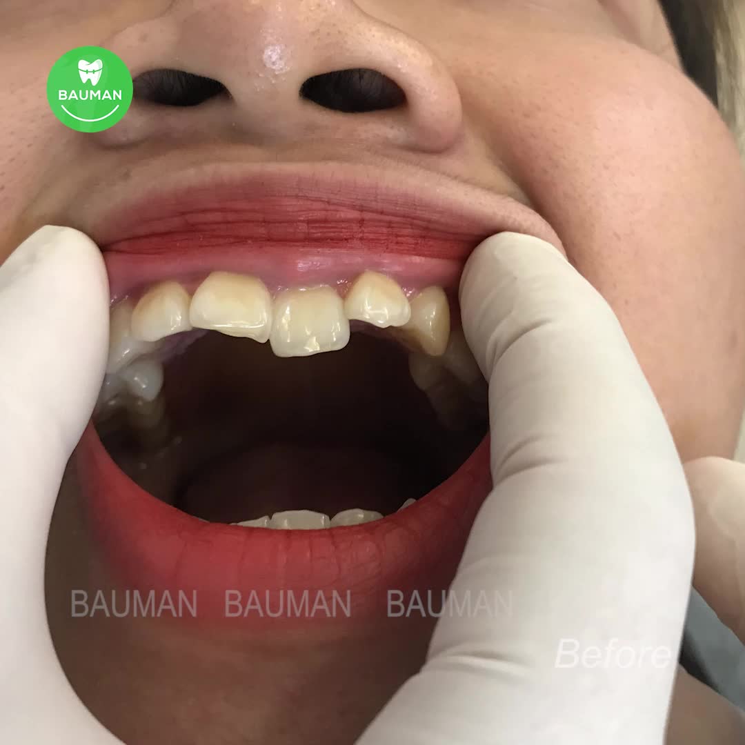 Ca niềng răng 5255 | Nha Khoa Bauman