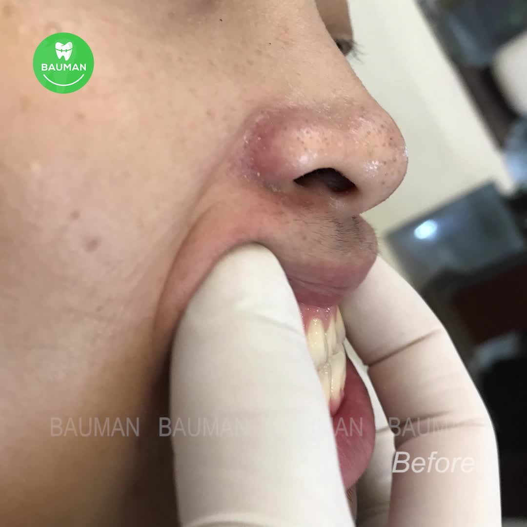Ca niềng răng 5266 | Nha Khoa Bauman