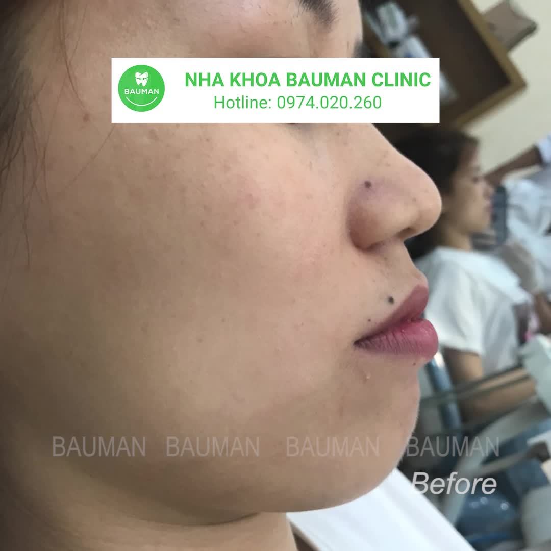 Ca niềng răng 5267 | Nha Khoa Bauman