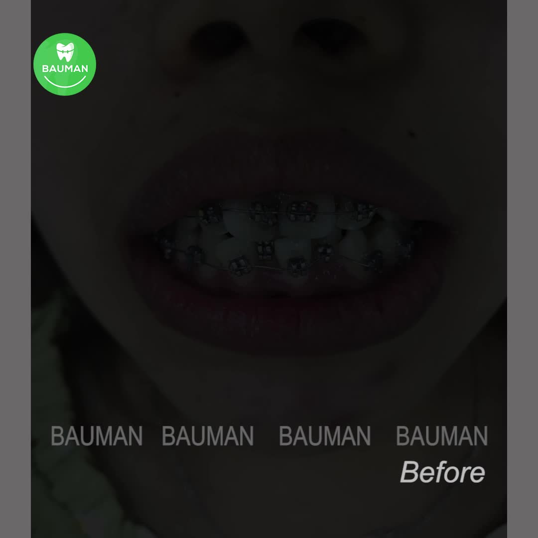 Ca niềng răng 5268 | Nha Khoa Bauman