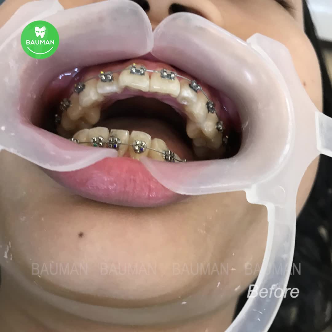 Ca niềng răng 5269 | Nha Khoa Bauman