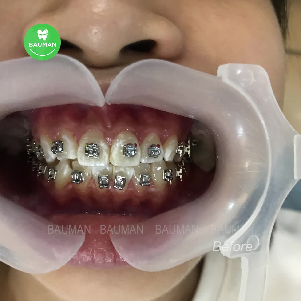 Ca niềng răng 5270 | Nha Khoa Bauman