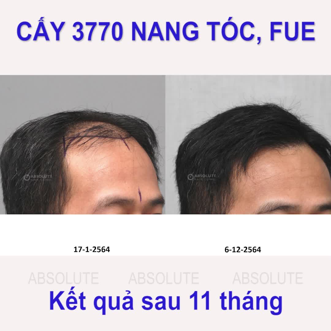 Cấy tóc tự thân trị hói đầu tại Absolute, 3770 nang tóc